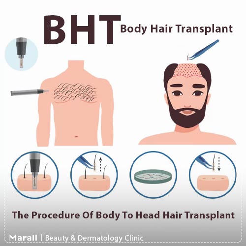 مراحل کاشت موی BHT