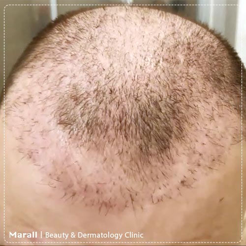 ریزش مو بعد از کاشت مو