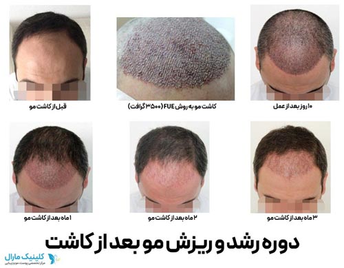 دوره رشد و ریزش مو بعد از کاشت مو